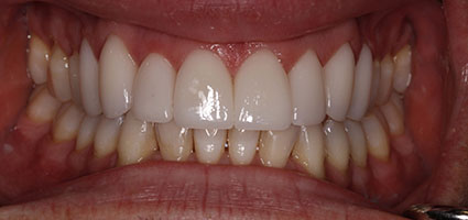 Porcelain Veneers
