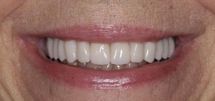 Porcelain Veneers