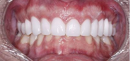 Porcelain Veneers