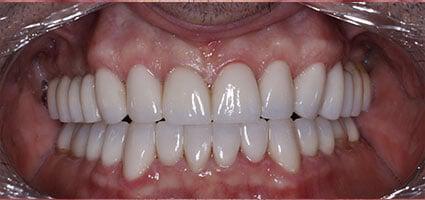 Porcelain Veneers