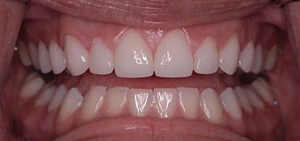 Porcelain Veneers