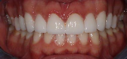 Porcelain Veneers
