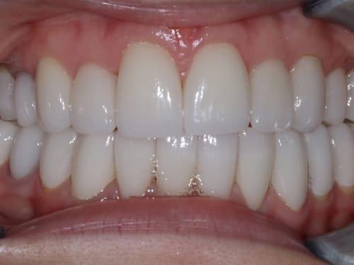 Porcelain Veneers