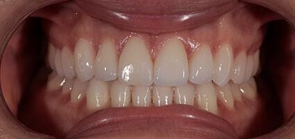 Porcelain Veneers