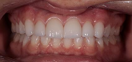 Porcelain Veneers