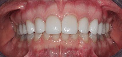 Crowns Upper
