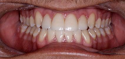 Anthony – Veneers
