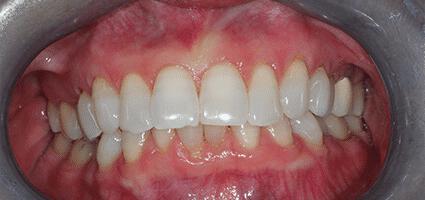 Laminate Veneers