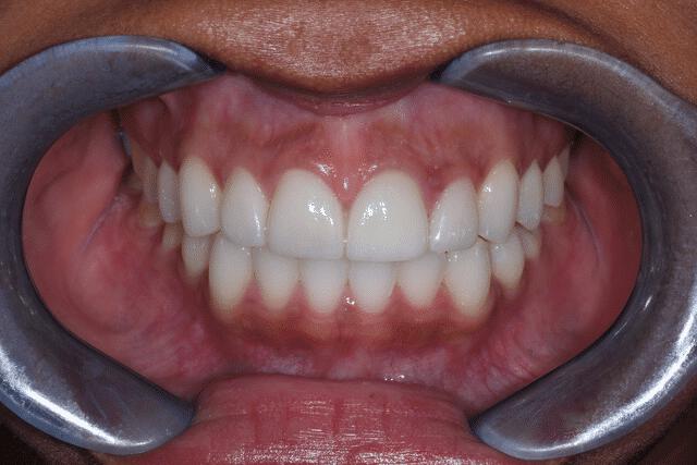 Upper Veneers