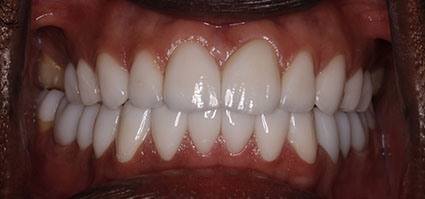 Smile Makeover/ Full Mouth Rehab