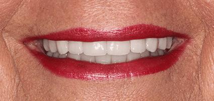 Full Mouth Reconstruction
