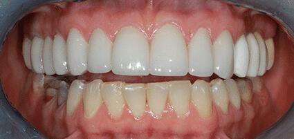 Full Mouth Reconstruction
