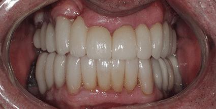 Full Mouth Reconstruction