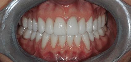Full Mouth Reconstruction