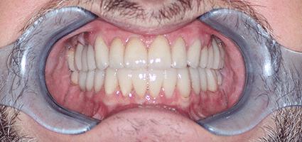 Full Mouth Reconstruction
