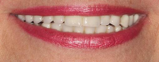 Full Mouth Reconstruction