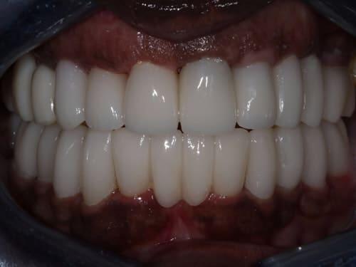 Full Mouth Reconstruction