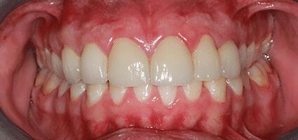 Upper Crowns