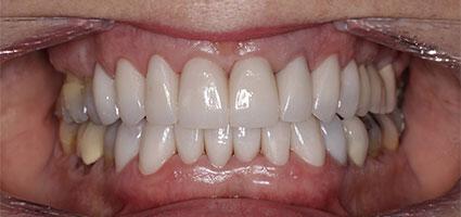 Porcelain Veneers