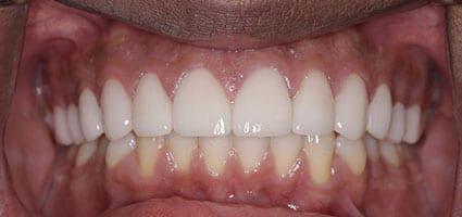 Porcelain Veneers and Invisalign