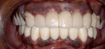 Full Mouth Reconstruction