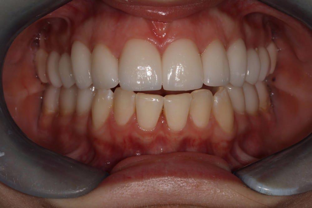 Full Mouth Reconstruction