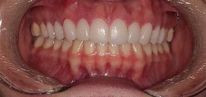 Laser Gum Lift and Porcelain Veneers