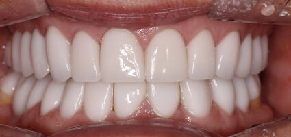 Smile Makeover