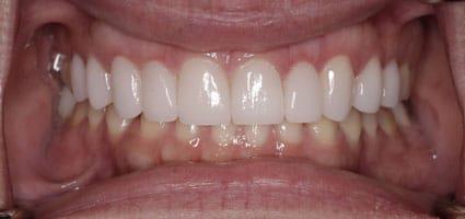 Teeth Brightening & Porcelain Veneers