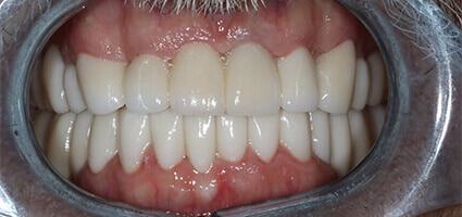 Full Mouth Reconstruction