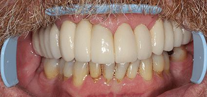 Crowns Full Upper