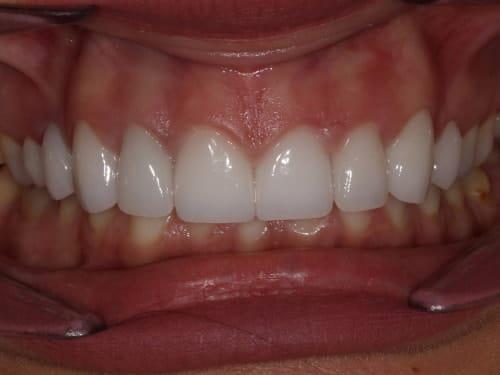 Porcelain Veneers