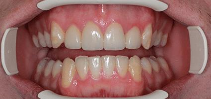 Laminate Veneers