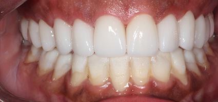 Full Mouth Reconstruction