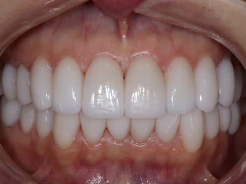 Porcelain Veneers