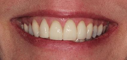 Laminate Veneers (upper)