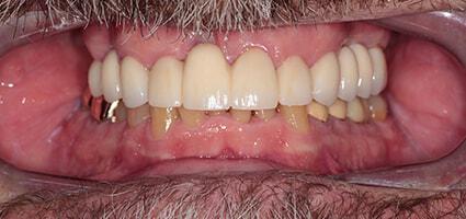 Dental Crowns and Bridge