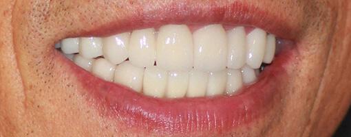 Porcelain Veneers and Dental Crowns
