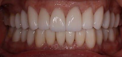 Full Mouth Reconstruction