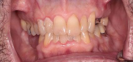 Full Mouth Reconstruction