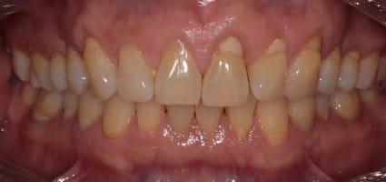 Full Mouth Reconstruction