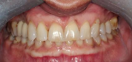 Full Mouth Reconstruction