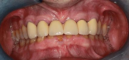 Full Mouth Reconstruction