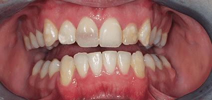 Laminate Veneers
