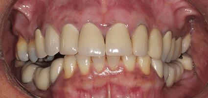Crowns Full Upper 2