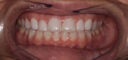 Porcelain Veneers