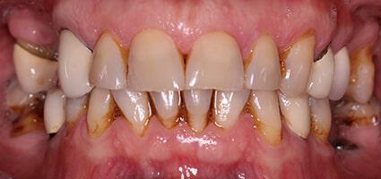 Full Mouth Reconstruction