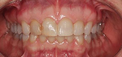 Crowns Upper