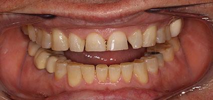 Facial Rejuvenation