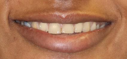 Porcelain Veneers